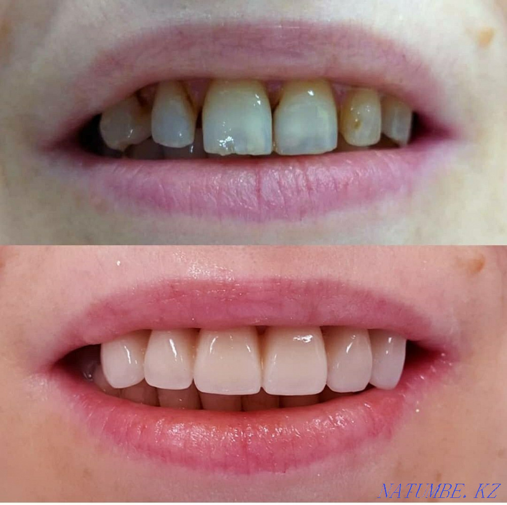 Implant. ACTION 80% discount. In dentistry Almaty - photo 6