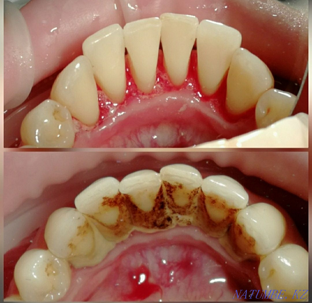 Implant. ACTION 80% discount. In dentistry Almaty - photo 5