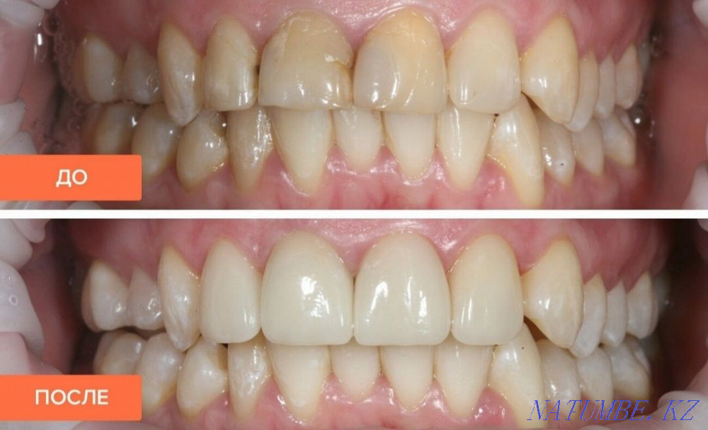 Имплантация зубов. Каспи Ред. Скидки в стоматологии Алматы - изображение 6