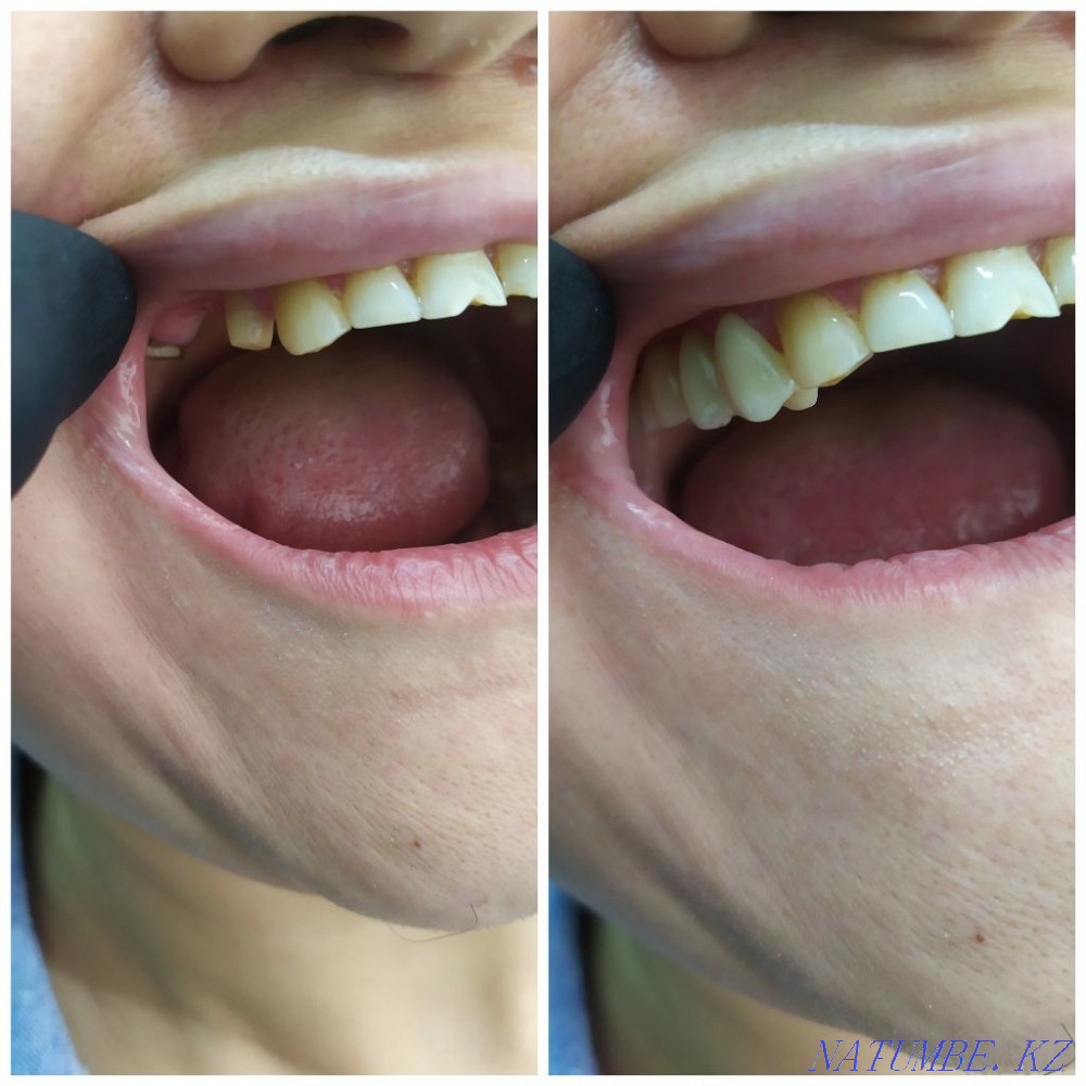 Имплант. Каспи Ред. Металлокерамика 12500 тг. Стоматология Алматы - изображение 3