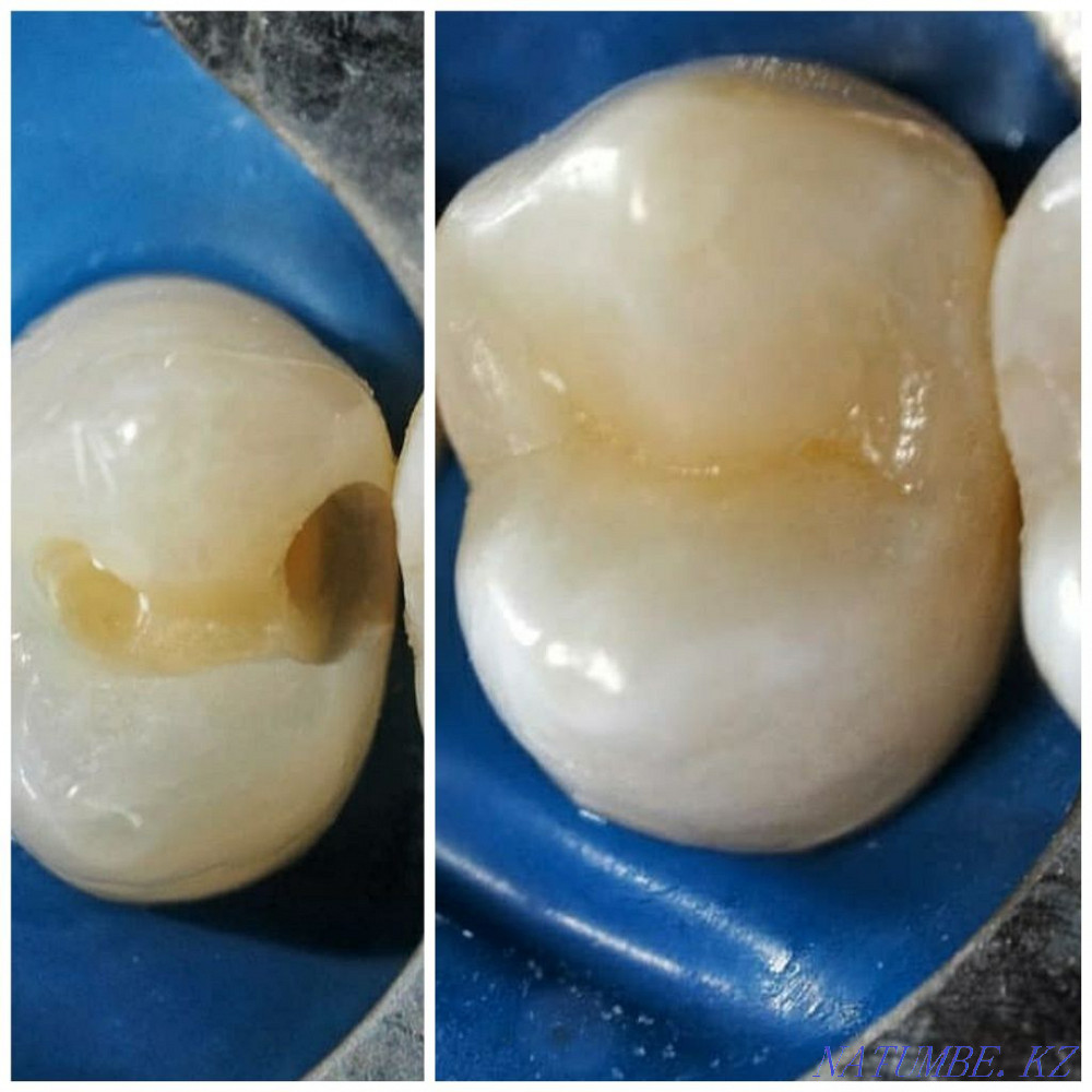 Имплант. Каспи Ред. Металлокерамика 12500 тг. Стоматология Алматы - изображение 5