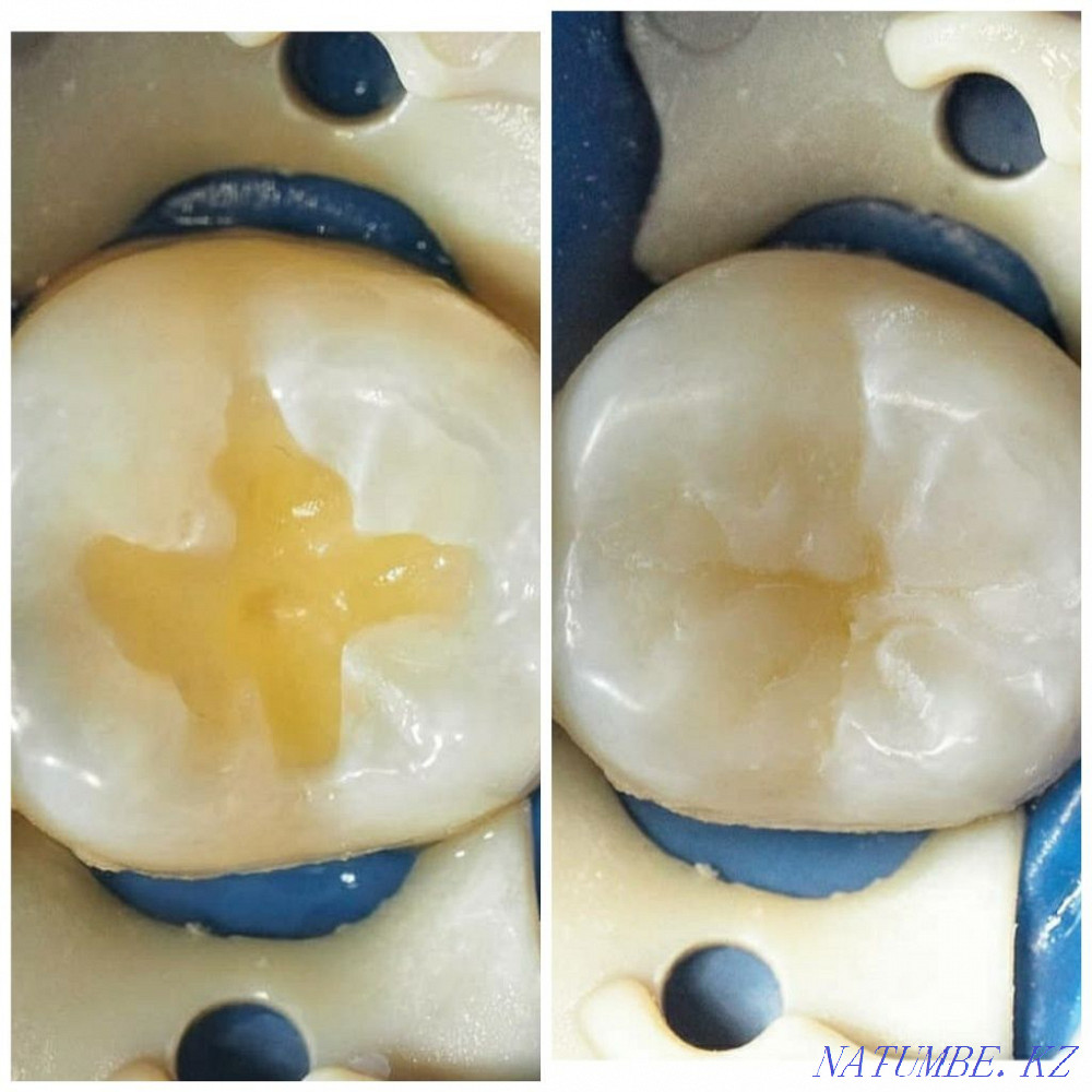 Имплант. Каспи Ред. Металлокерамика 12500 тг. Стоматология Алматы - изображение 6
