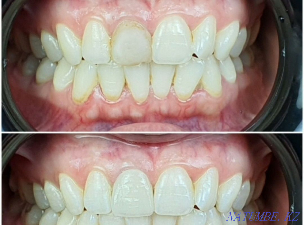 Имплант. Каспи Ред. Металлокерамика 12500 тг. Стоматология Алматы - изображение 2