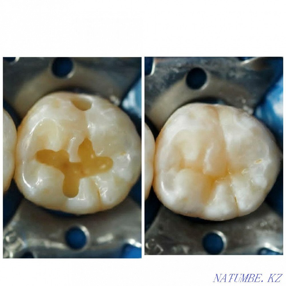 Имплант. Каспи Ред. Металлокерамика 12500 тг. Стоматология Алматы - изображение 7