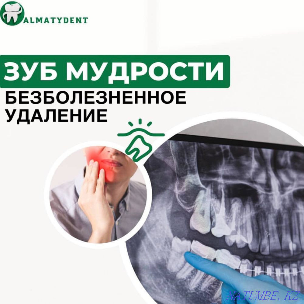 Импланты 55.000тенге. Акция в стоматологии. Алматы - изображение 1