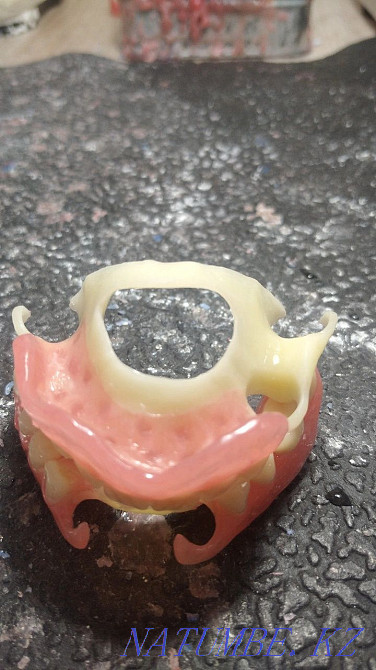 Протезировани зубов. Протездер жасаймыз Белоярка - изображение 5