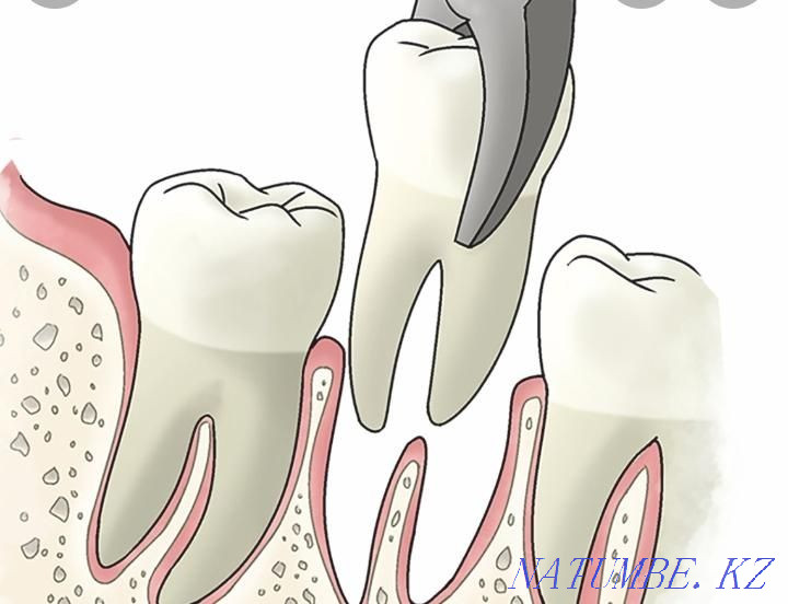Complicated tooth extraction Astana - photo 1