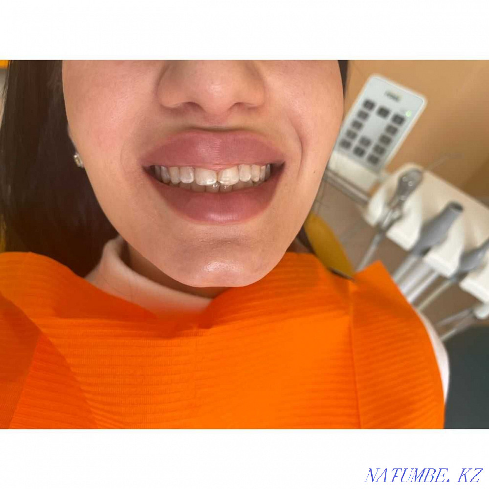 стоматология чистка отбеливания зубов Алматы - изображение 7