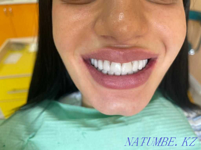 стоматология чистка отбеливания зубов Алматы - изображение 8