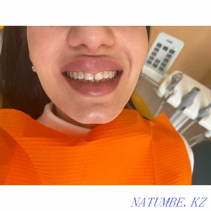 dentistry cleaning teeth whitening Almaty - photo 7