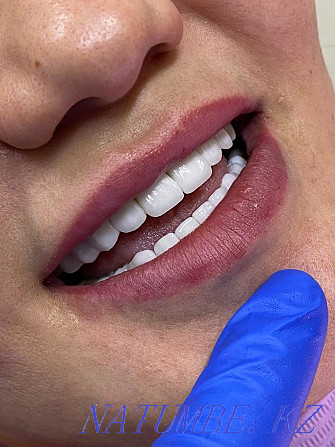 Veneers Zirconia Crowns Prosthetics Almaty - photo 1