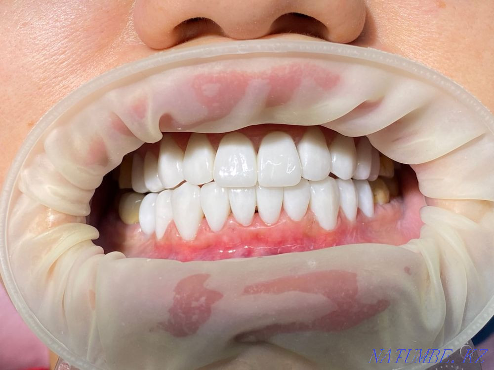 Виниры Цирконий Коронки Протезирование Алматы - изображение 2