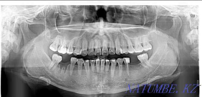 Gendex dental x-ray machine Almaty - photo 4