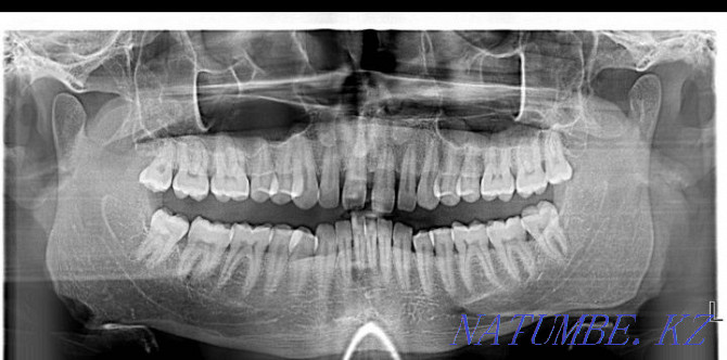 Gendex dental x-ray machine Almaty - photo 5