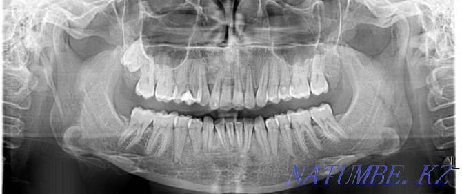 Gendex dental x-ray machine Almaty - photo 3