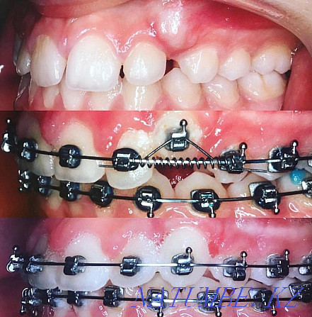 Braces! Discount 50% 50000tg Almaty - photo 1