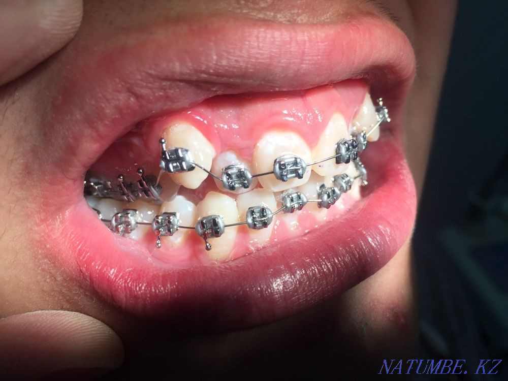 Брекеты! Скидка 50% 50000тг Алматы - изображение 5