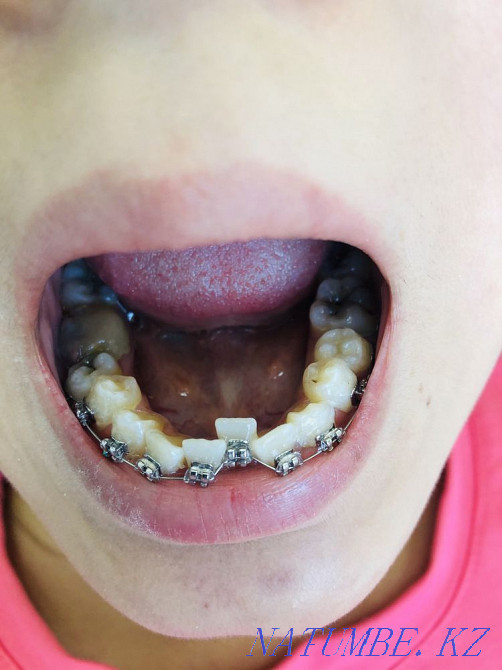 Брекеты! Скидка 50% 50000тг Алматы - изображение 8