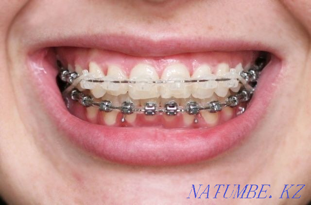 Брекеты! Скидка 50% 50000тг Алматы - изображение 3