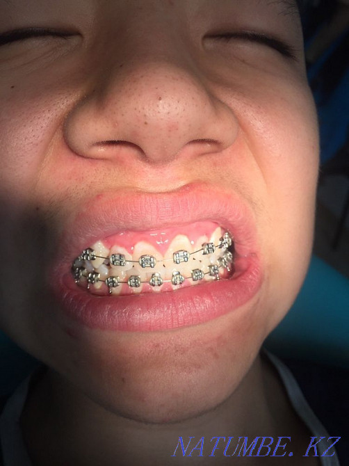 Брекеты! Скидка 50% 50000тг Алматы - изображение 6