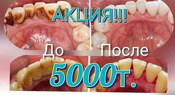Чистка зубов от камней и налета 5000т.Абая Алтынсарина. Almaty
