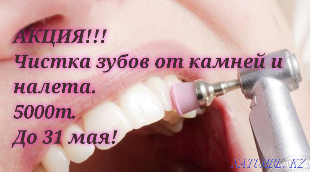 Чистка зубов от камней и налета 5000т.Абая Алтынсарина. Алматы - изображение 2