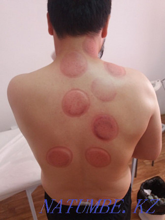 Hijama massage Atyrau - photo 3