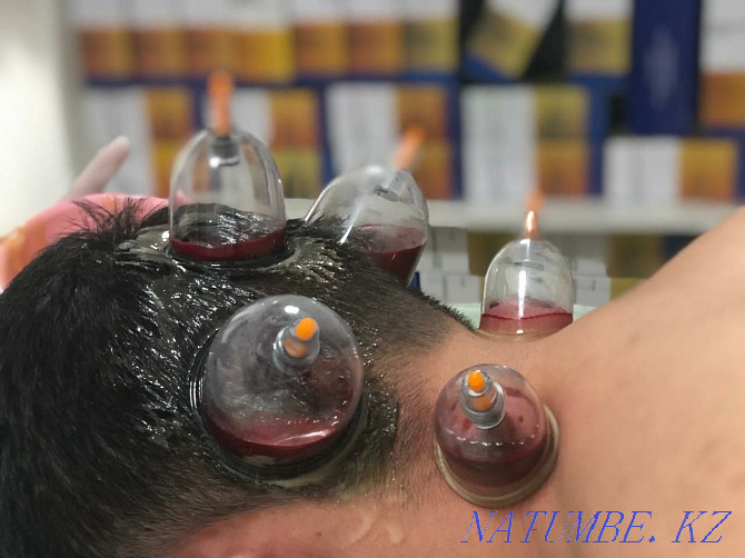 Hijama massage Atyrau - photo 1