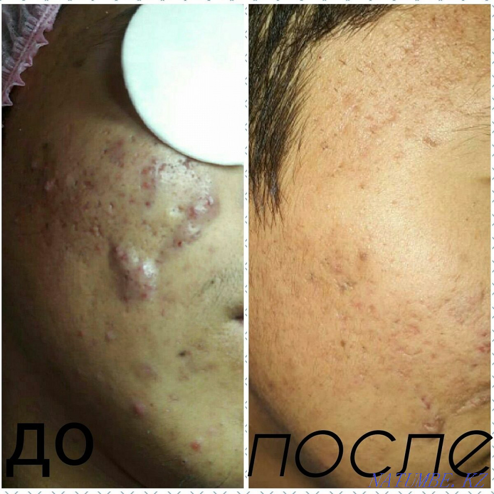 Хиджама массаж Атырау - изображение 2