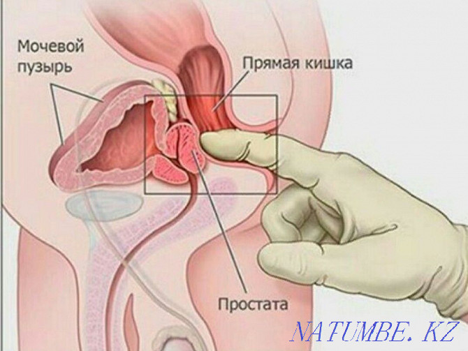 Ерлердің денсаулығына арналған массаж/Урологиялық/Простата.  Астана - изображение 3