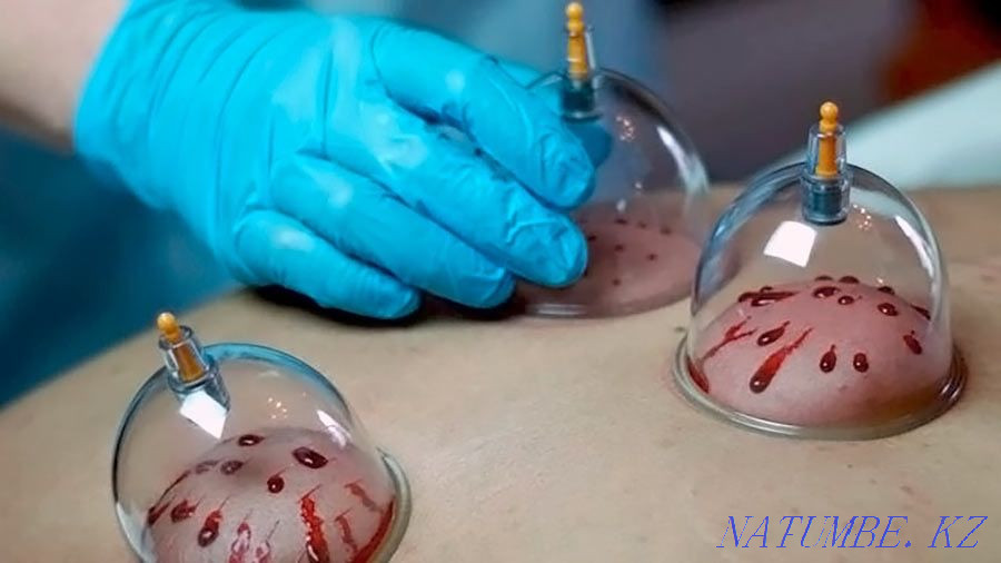 Лечение пиявками хиджама Атырау - изображение 3