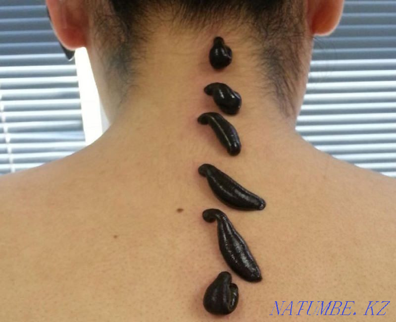 Лечение пиявками хиджама Атырау - изображение 2