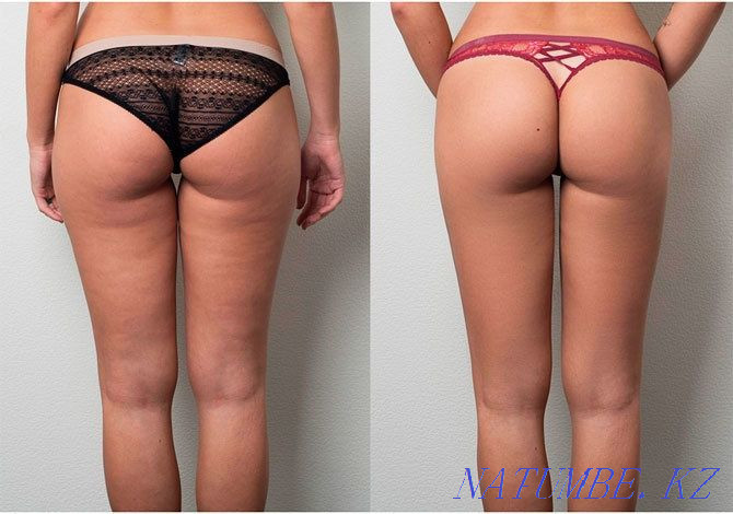Антицеллюлитный массаж Актау - изображение 2