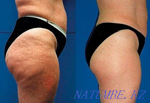 Антицеллюлитный массаж Актау - изображение 1