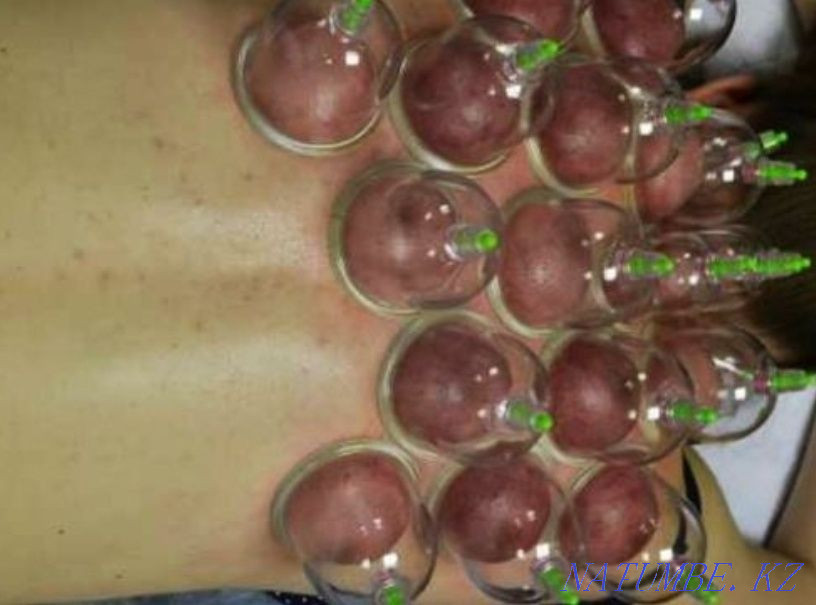 Массаж, хиджама, физеотерапия Алматы - изображение 3