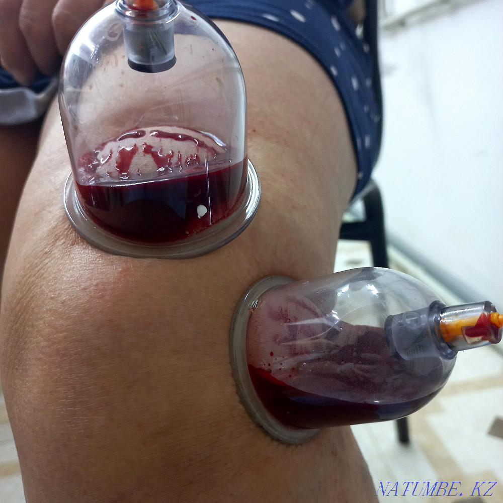 Профессиональный массаж и хиджама Караганда - изображение 3