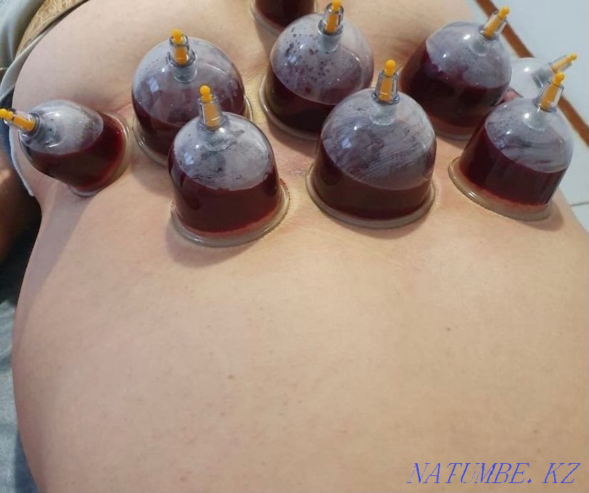 Hijama Massage  - photo 6