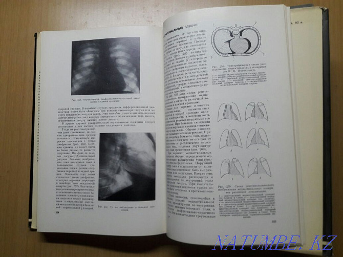 Bookinistry. X-ray diagnosis of pulmonary tuberculosis. Karagandy - photo 2