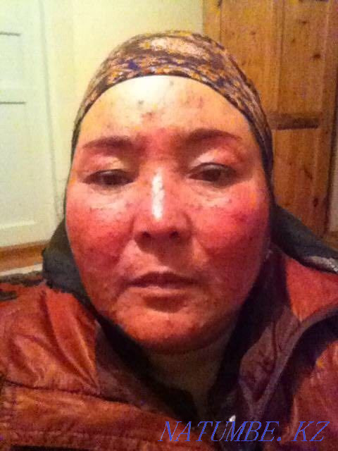 Псориаз.Экзема.Витилиго турлі тері ауруларын емдейміз. Шымкент - изображение 5