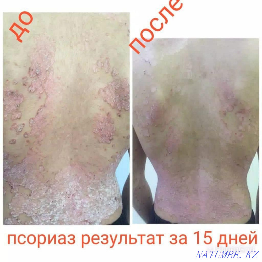 Псориаз.Экзема.Витилиго турлі тері ауруларын емдейміз. Шымкент - изображение 2