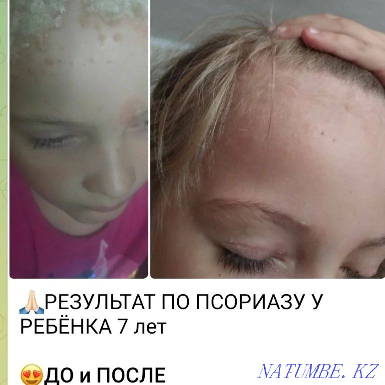 Псориаз.Экзема.Витилиго турлі тері ауруларын емдейміз. Шымкент - изображение 1