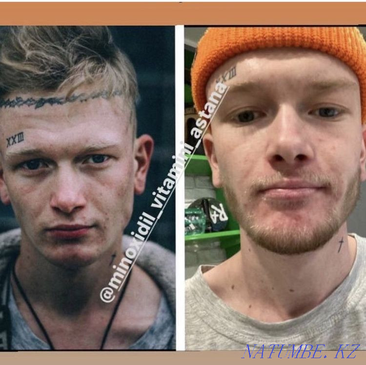 Minoxidil for hair and beard growth. Minoxidil Kirkland. Astana - photo 3