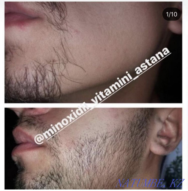 Minoxidil for hair and beard growth. Minoxidil Kirkland. Astana - photo 4