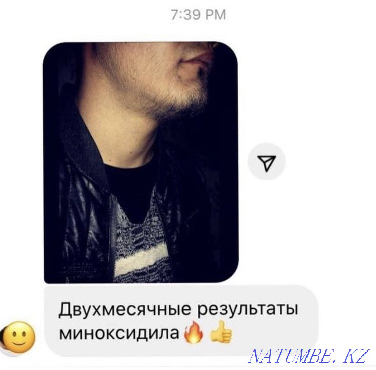 Minoxidil for hair and beard growth. Minoxidil Kirkland. Astana - photo 2