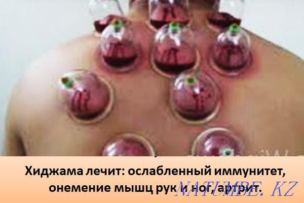 Массажные, вакуумные банки Ихлас 4700тг Есть Каспи Ред +10% Алматы - изображение 1