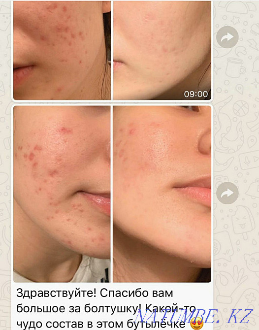Лекарства для проблемной кожи Нурмухамеда Есентаева - изображение 8