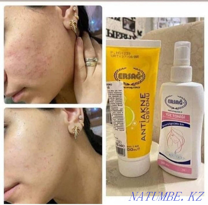 Anti-acne lotion  - photo 2