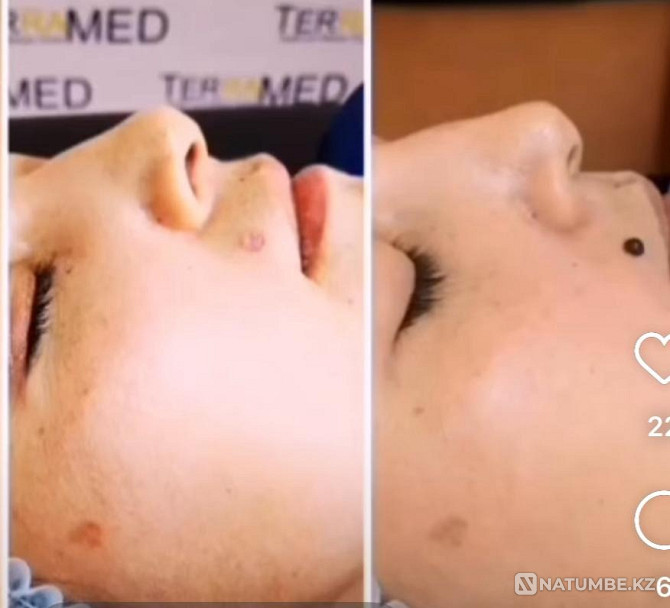 Laser removal of warts and moles Shymkent - photo 4