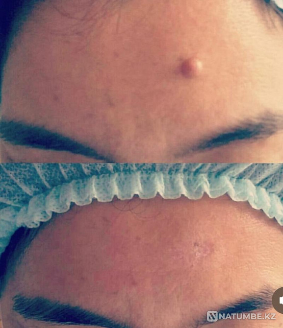 Laser removal of warts and moles Shymkent - photo 2