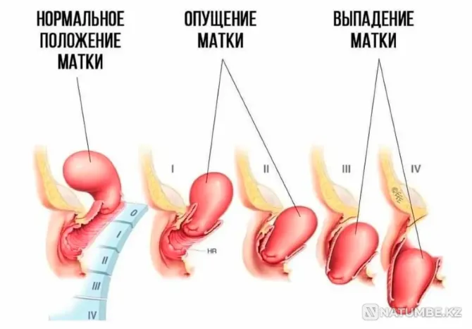 Обучаем делать гинекологический массаж Алматы - изображение 1